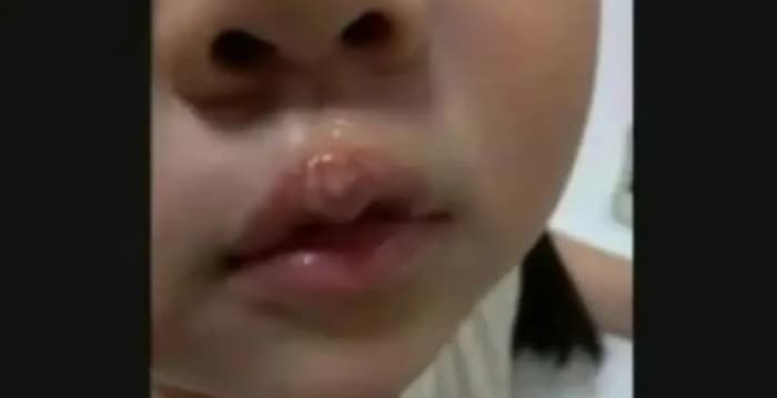 江苏徐州幼童被曝遭教师用热熔胶烫嘴
