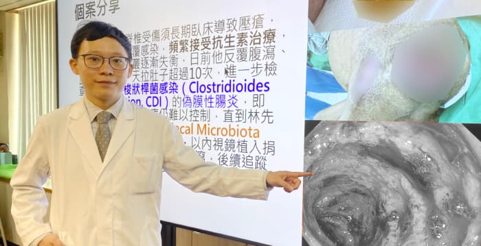 卧床男一天狂拉10次 粪菌移植终结腹泻、血便之苦