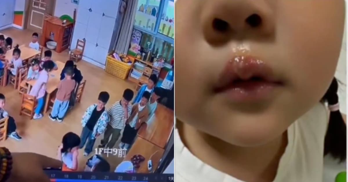 江蘇幼兒園老師虐童 用熱熔膠燙孩子嘴唇(視頻)