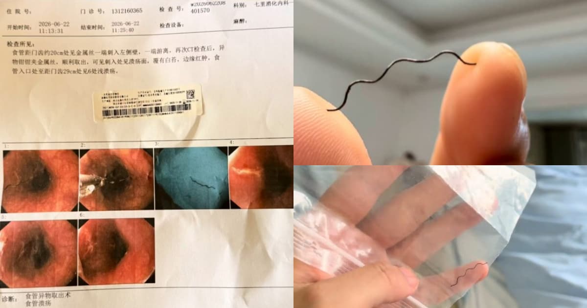 恐怖!女子吃火鍋吞2.2厘米硬鐵絲 喉嚨劃傷(視頻)